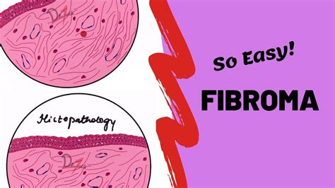 Irritation Fibroma Histology