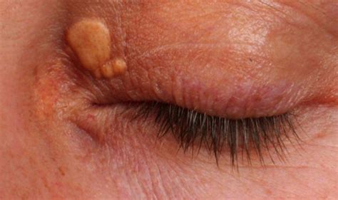 High cholesterol symptoms: Lump around eyes could be warning sign | Express.co.uk