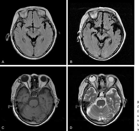 Figure 1 from WEBINO (Walleyed Bilateral Internuclear Ophthalmoplegia) Syndrome in Progressive ...