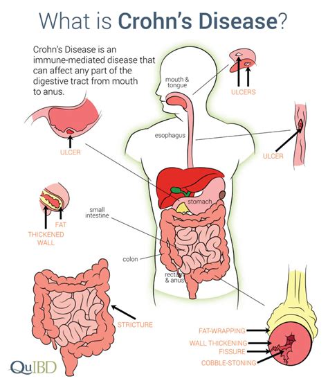 Crohn's Disease Symptoms Prevalence Impact Causes