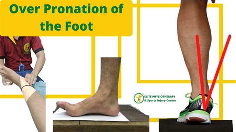 Over Pronation of the Foot