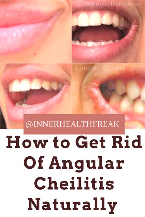 ANGULAR CHEILITIS REMEDY NATURAL – Inner Health Freak