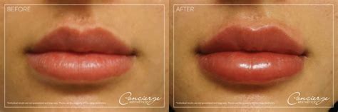 Before and After Photos - Juvéderm Volbella - Lips | Concierge Aesthetics