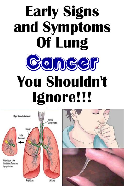 Lung Cancer Signs And Symptoms