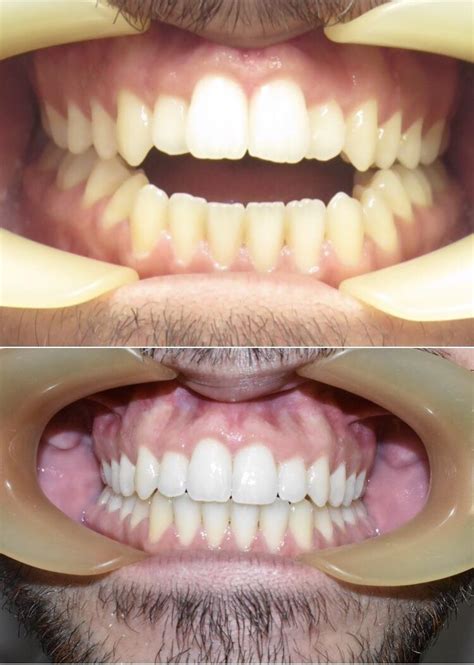 Before and after, open bite case. : r/Invisalign