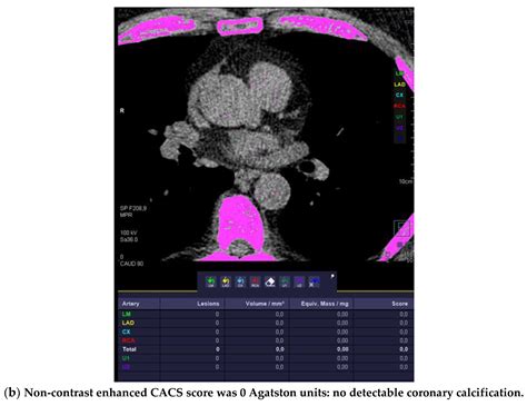 The Atherosclerosis Profile by Coronary Computed Tomography Angiography (CTA) in Symptomatic ...