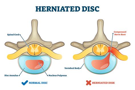 Herniated disc injury as labeled spinal pain explanation vector | The Proactive Athelete