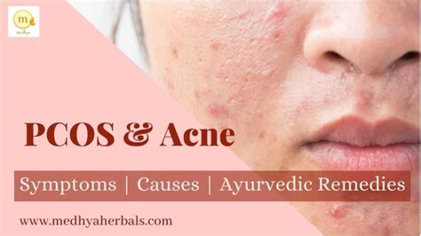 PCOS Acne Treatment in Ayurveda: A Doctor's Guide