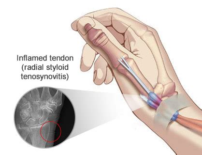 Tratamiento de la tenosinovitis estiloidea radial Doctores en Brooklyn NYC