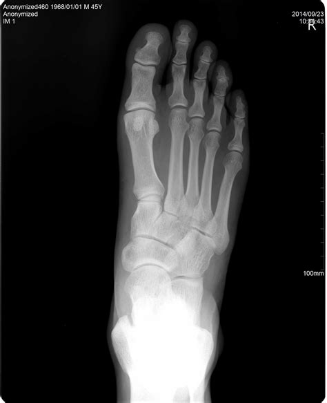Foot AP digital x-ray image made by a CR unit. | How to make image, X ...