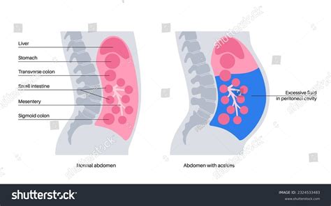 637 Distension Distension Images, Stock Photos & Vectors | Shutterstock