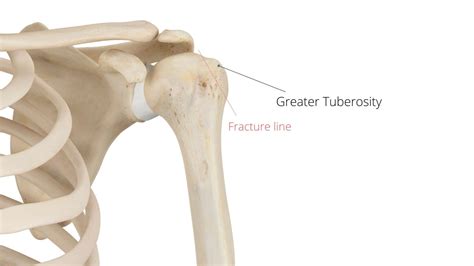 Greater Tuberosity Fracture Exercises