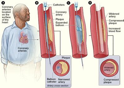 Coronary Angioplasty / Stents