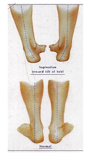 Common Issues with Feet