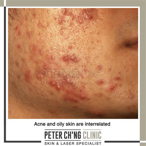 5 Problems All People with Oily Skin Can Relate To | Peter Ch'ng Skin Specialist - KL, Malaysia