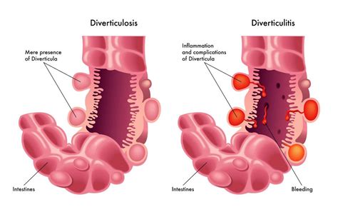 Pooping Blood? Here are Some Common Causes of Blood in Stool | Page 6 | Things Health