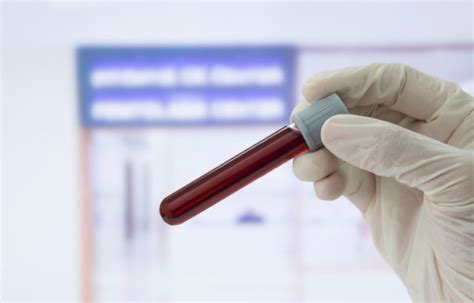 Optimal ANA Cutoff Titer as Entry Criterion for SLE Classification - Rheumatology Advisor