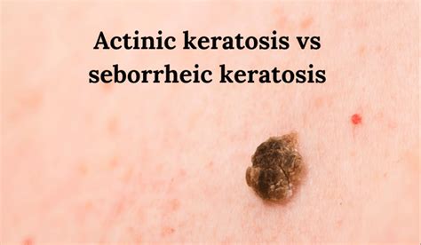 Actinic Keratosis vs Seborrheic Keratosis | Vujevich Dermatology