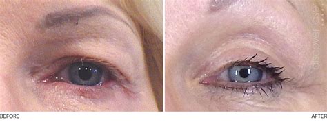 Plexr non-surgical blepharoplasty - Aesthetic Clinic Burnley Lancashire