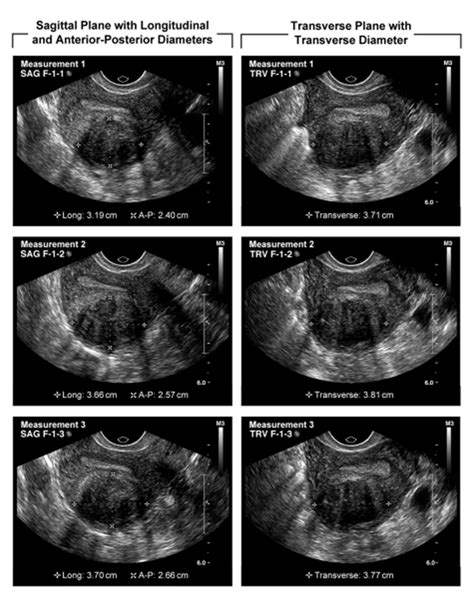 Intraobserver Variability in Fibroid Size Measurements - Moshesh - 2014 - Journal of Ultrasound ...