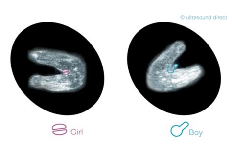 3 lines on your ultrasound - can it predict your baby's sex? - MadeForMums