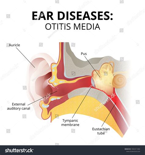 Acute Otitis External: Over 5 Royalty-Free Licensable Stock Vectors & Vector Art | Shutterstock