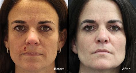 Reconstructive Surgery Photos | Princeton, NJ | Patient 8729