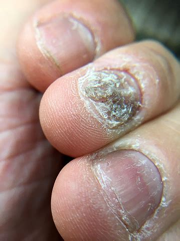 Big Close Up Of Fungus Infection On Nails Hand Finger With Onychomycosis Fungal Infection On ...