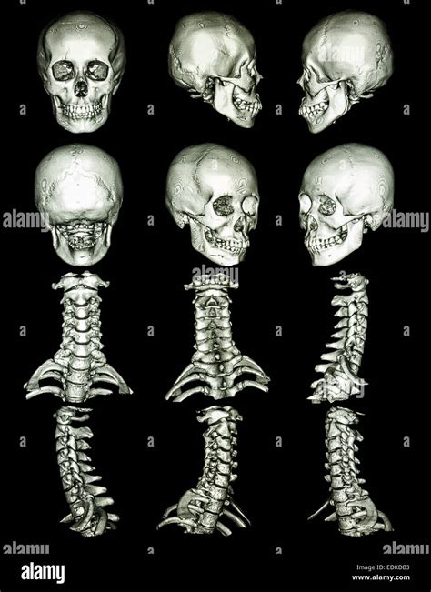 CT scan (Computed tomography) with 3D graphic show normal human's skull ...