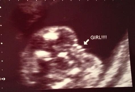 How to Make a Smile: Baby Girl - 20 week ultrasound