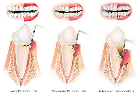Periodontics (Gum Treatment) | Dentist in Puchong