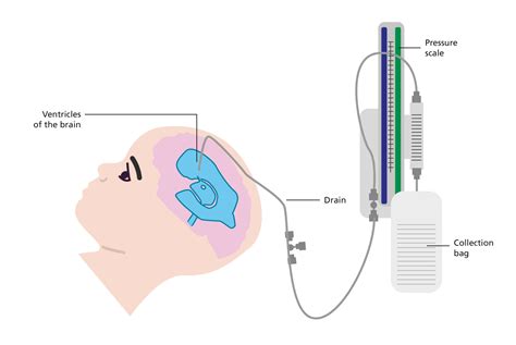 External Ventricular Drain Evd