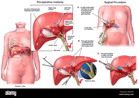 L'ablation chirurgicale de la vésicule biliaire Photo Stock - Alamy