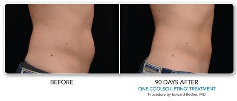 CoolSculpting for Men | La Jolla Cosmetic Surgery Centre & Medical Spa