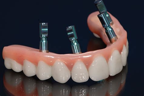 All-on-4 Dental Restorative Options - Tooth Replacement Options