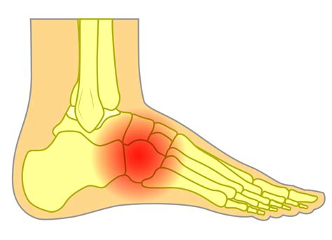 Midfoot Sprain - Upswing Health | Upswing Health