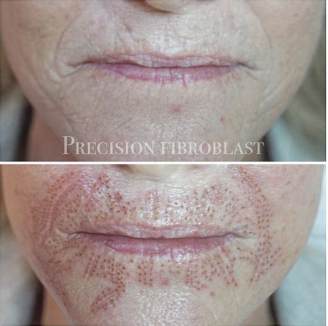 Plasma Fibroblast — Precision Spa