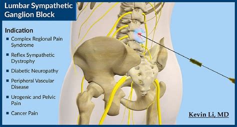 Cenar Donación Espesar nerve block for back pain Tahití Víspera cortina