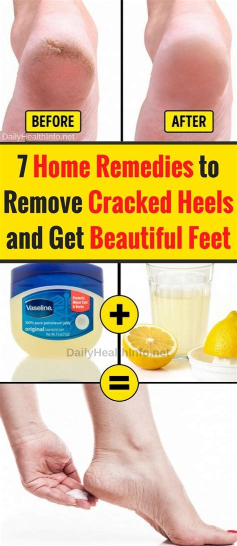 Dry Cracked Feet, and How to Fix Them...steve needs to do this! | Cracked feet remedies, Dry ...