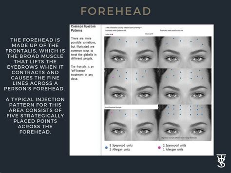 Top 3 BOTOX Injection Patterns + Markup | SkinViva Training