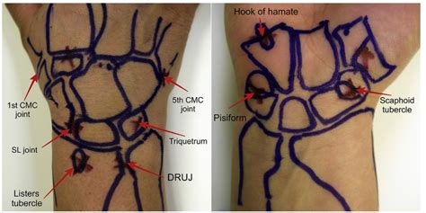 Differential Diagnosis of Radial-Side Wrist Pain [+FREE EBOOK] - ReHand: Rehabilitation of hand ...