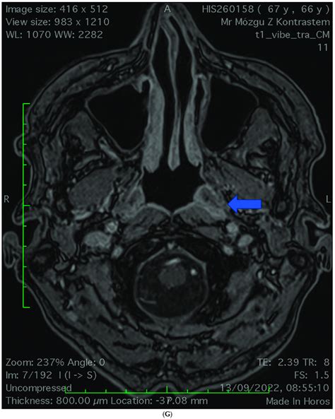 (A) Patient 1 (the initial stage of the disease). CT scan ...