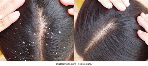 Image Before After Dandruff Treatment Shampoo Stock Photo 1981847237 ...