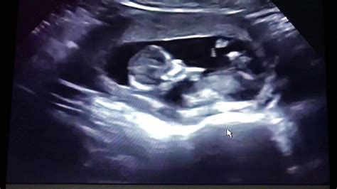 26 Week Twin Ultrasound