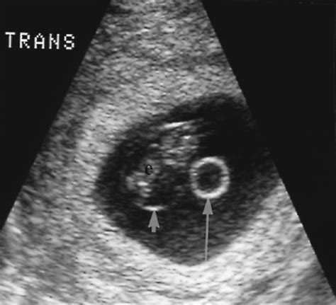 Obstetric Ultrasound First Trimester | Radiology Key