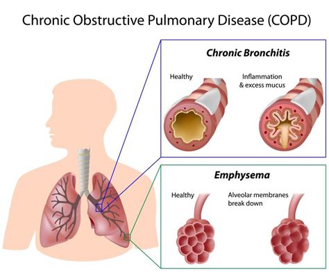 NM-Tracking - COPD