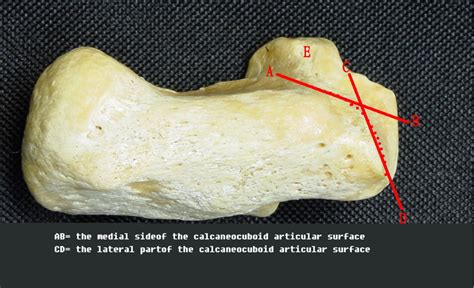 Applied anatomy of the calcaneocuboid articular surface for internal ...