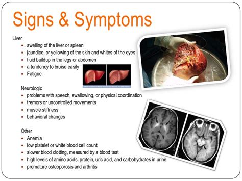 Wilson Disease- Table 5