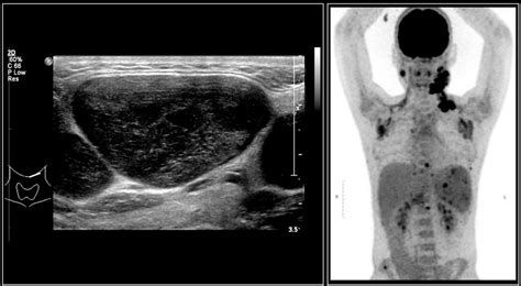 Lymphoma Neck Ultrasound