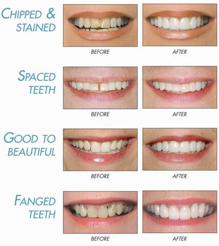 Veneers / Lumineers | MST Family Dentistry and Cosmetic Center